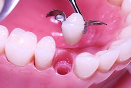 best dentists henry county - crowns mcdonough ga