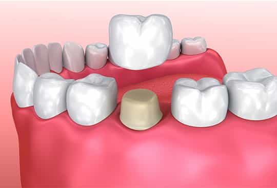 Bridges McDonough GA - Dentist Henry County - Dental Care GA