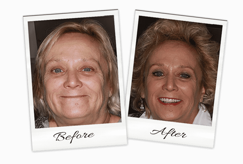 Dentures-1