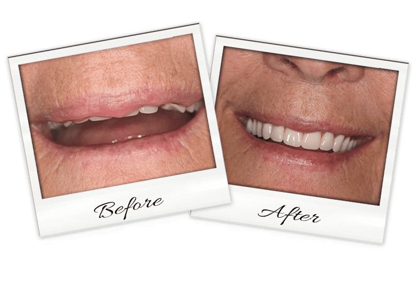 Dentures-2