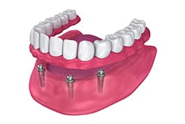 dentures and partials mcdonough ga - family dentists henry county
