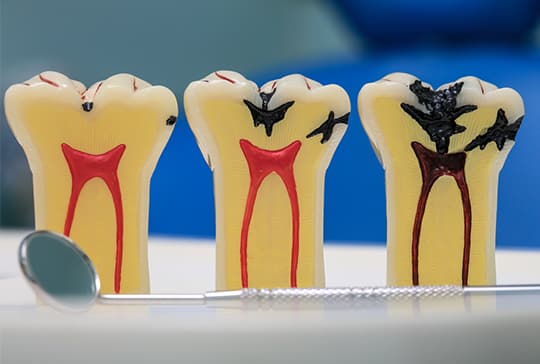 best dentists ga - root canal therapy mcdonough - endodontic treatment henry county ga