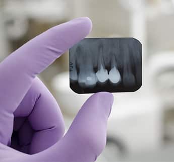 endodontics dentistry mcdonough ga - root canals dental care