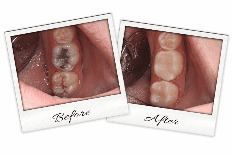 Fillings-1
