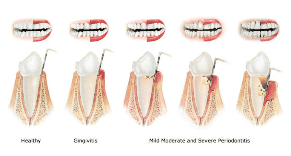periodontal disease care mcdonough ga - best dentists in henry county